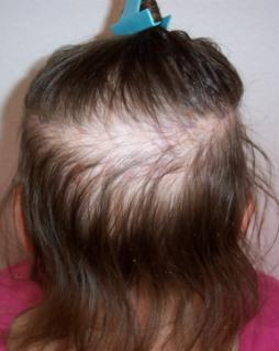 Pictures of What Your Hair and Scalp Say About Your Health ...